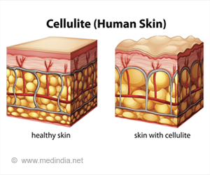 Cellulitis - Causes Symptoms Diagnosis Treatment How to Avoid