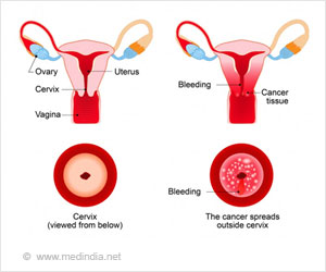 Cervical Cancer - Types, Causes, Symptoms, Diagnosis, Treatment, Complications & Prevention