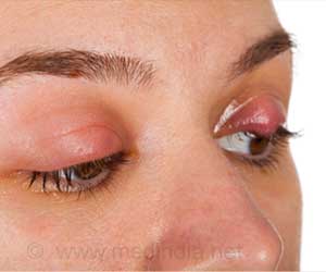 Chalazion (Eyelid Condition) - Causes, Symptoms, Signs, Diagnosis, Treatment, Prevention