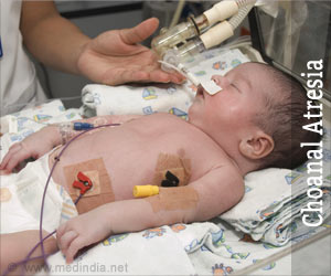 Choanal Atresia Causes, Symptoms, Diagnosis, Treatment and Prevention