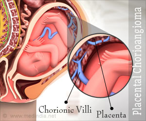 Chorioangioma - Causes, Symptoms, Signs, Diagnosis, Treatment, Prevention