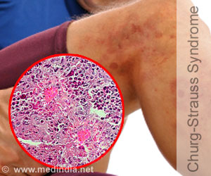 Churg-Strauss Syndrome: Causes, Symptoms, Diagnosis & Treatment