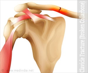 Clavicle Fracture / Broken Collarbone - Symptoms, Diagnosis, Treatment, Prognosis