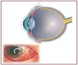 About Conjunctivitis | Pink Eye