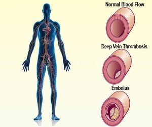 Deep Vein Thrombosis (DVT) - Causes - Symptoms - Diagnosis - Treatment - Complications - Prevention