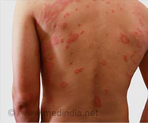 Drug Hypersensitivity - Causes, Symptoms, Types, Diagnosis, Treatment, Risk Factors and Prevention