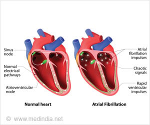 Drugs for Atrial Fibrillation - Symptoms, Treatment, Side Effects & Precautions