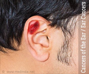 Cancers of the Ear / Ear Cancers Causes, Symptoms, Diagnosis, Treatment and Prevention