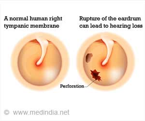 Eardrum Perforation - Causes, Symptoms, Diagnosis & Treatment