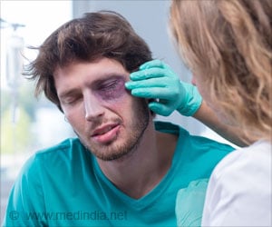 Ecchymosis - Causes, Types, Symptoms, Diagnosis, Complications, Treatment & Prevention