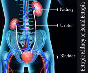 Ectopic Kidney | Renal Ectopia - Causes, Symptoms, Diagnosis, Treatment, Complications