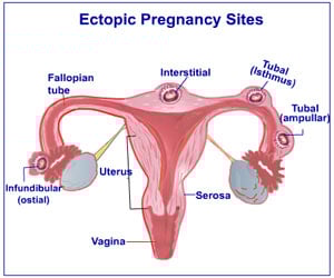 Ectopic Pregnancy - Causes - Symptoms - Diagnosis - Treatment - FAQs