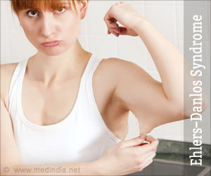 Ehlers-Danlos syndrome: Symptoms Diagnosis Treatment