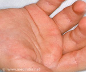 Farber disease-Causes-Symptoms-Diagnosis-Treatment-Prognosis-Prevention-FAQs