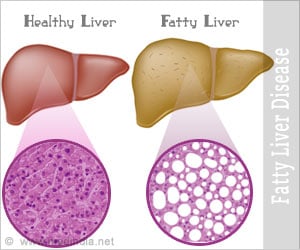 Fatty Liver Disease: A Growing Health Problem in India - Causes, Symptoms, Diagnosis, Treatment