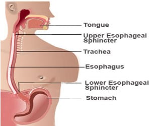 Gastroesophageal Reflux Disease (GERD)
