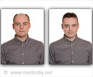 Hair Restoration-Medical-Surgical-Cosmetic Hair Thickeners and Wigs