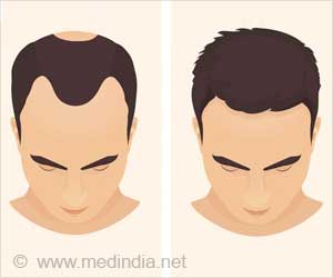 Hair Replacement for Men