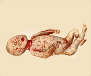 Harlequin Ichthyosis - Cause, Symptoms, Diagnosis and Treatment