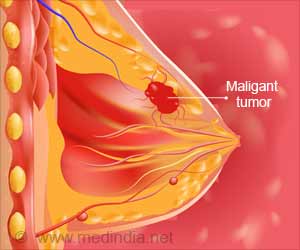 HER2 Positive Breast Cancer | HER2/neu Breast Cancer