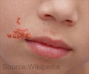 Impetigo - Symptoms, Causes, Complications, Diagnosis, Treatment & Prevention
