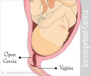 Incompetent Cervix | Cervical Insufficiency - Causes, Symptoms, Diagnosis, Treatment