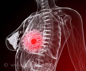 Inherited Breast Cancer Syndromes