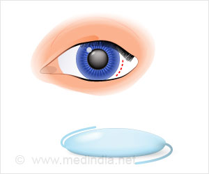 Intraocular Lens Implants (IOL) - Types, Procedure, Recovery & Complications