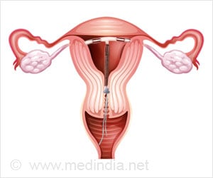 Intrauterine Device - One of The Most Reliable Methods of Contraception