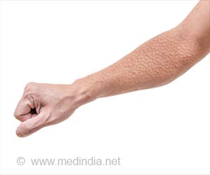 Keratosis Pilaris (Chicken Skin) - Skin Disorder: Causes, Symptoms, Diagnosis and Treatment