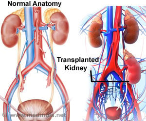 About Transplantation