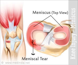 Meniscal Tears - Causes, Symptoms, Diagnosis, Treatment