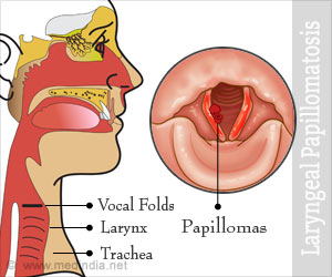 Laryngeal Papillomatosis - Causes, Symptoms, Diagnosis, Treatment, Health Tips