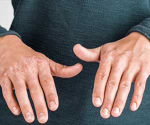 Lichen Sclerosus - Causes Symptoms Diagnosis Treatment