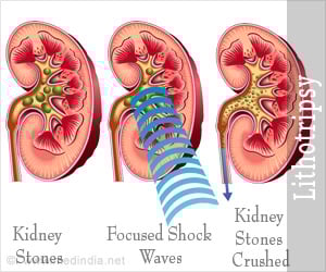 Lithotripsy - Purpose, Techniques, Procedure, Advantages, Disadvantages, Risks