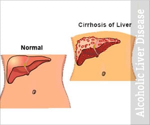 Alcoholic Liver Disease - Causes Symptoms Diagnosis Treatment FAQs