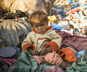 Malnutrition - Causes, Symptoms, Diagnosis, Treatment & Prevention