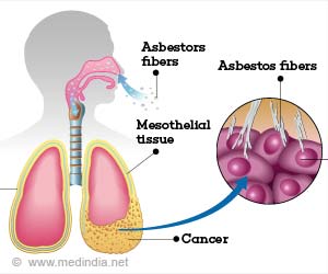 Mesothelioma - Causes, Symptoms, Diagnosis, Treatment & Prevention