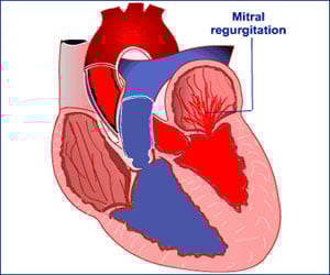 Mitral Valve Regurgitation | Mitral Valve Replacement | Mitral Valve Stenosis - General Information