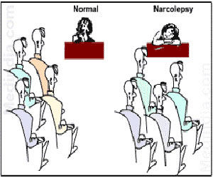 Narcolepsy - Overview Incidence Causes Symptoms Diagnosis Treatment Prognosis Prevention FAQs