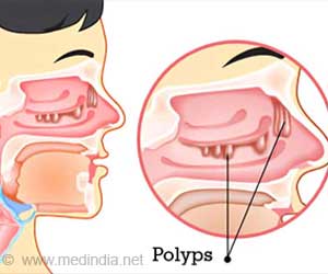 Nasal Polyp - Causes, Symptoms, Diagnosis, Treatment, Health Tips