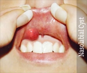 Nasolabial Cyst - Causes, Symptoms, Diagnosis, Treatment