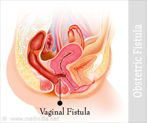 Obstetric Fistula - Causes, Symptoms, Diagnosis, Treatment, Prevention, Health Tips