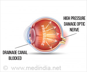 Ocular Hypertension - Causes, Symptoms, Diagnosis, Treatment & Prevention
