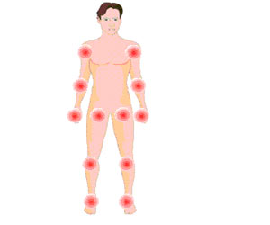 Oligoarthritis | Children and Arthritis - Types, Diagnosis, Treatment