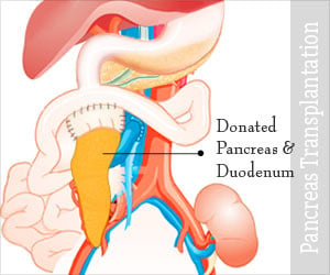 Pancreas Transplantation - Procedure, Evaluation, Preparation, Surgery, After care