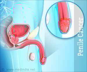 Penile Cancer | Cancer of the Penis – Risk Factors Symptoms Diagnosis Treatment