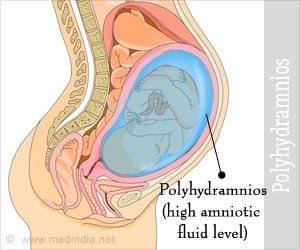 What do you need to know about Polyhydramnios?