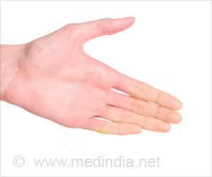 Raynaud’s - Causes, Symptoms, Diagnosis, Treatment & Prevention