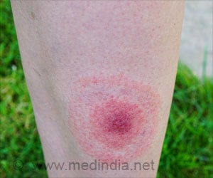 Relapsing Fever - Causes, Symptoms, Complications, Diagnosis & Treatment